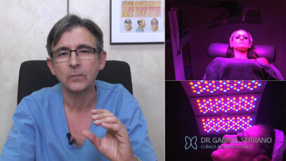 Acné con Clorofilina